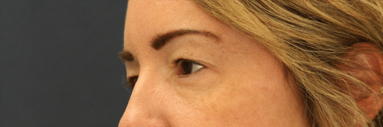 Before Image: Upper Blepharoplasty - left-front-oblique