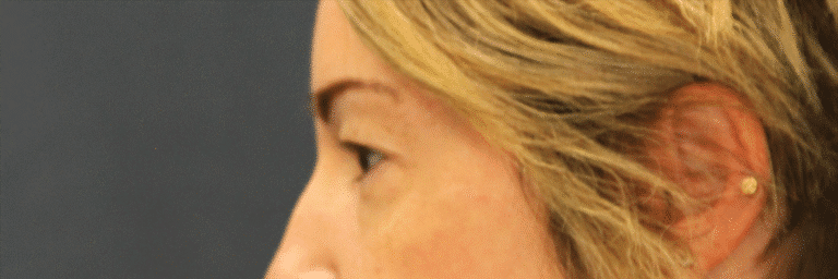 Before Image: Upper Blepharoplasty - left-side