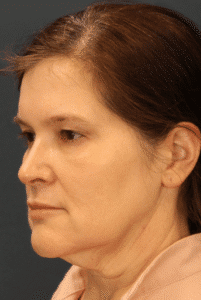 Before Image: MyEllevate Minimally Invasive Neck Lift