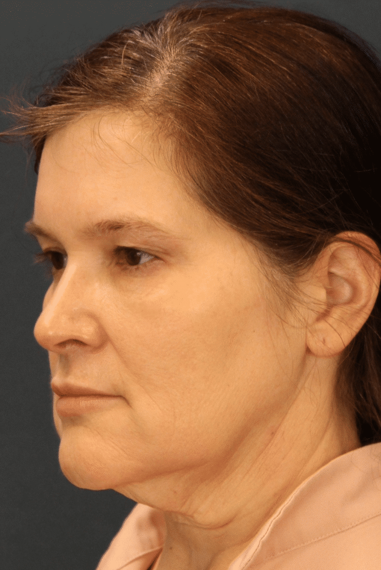Before Image: MyEllevate Minimally Invasive Neck Lift - left-front-oblique