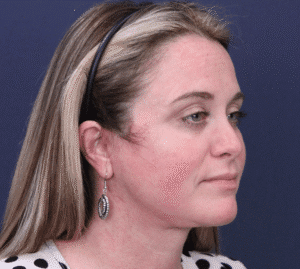 After Image: Facelift and Extended Deep Plane Neck Lift