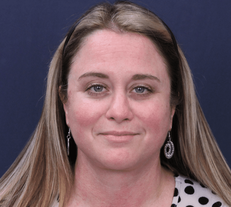 After Image: Facelift and Extended Deep Plane Neck Lift - front