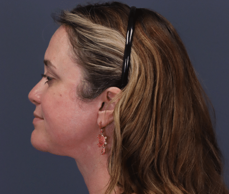 After Image: Facelift and Extended Deep Plane Neck Lift - left-side