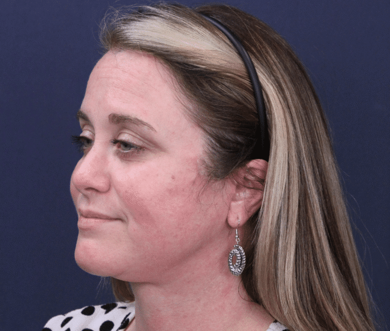 After Image: Facelift and Extended Deep Plane Neck Lift - left-side