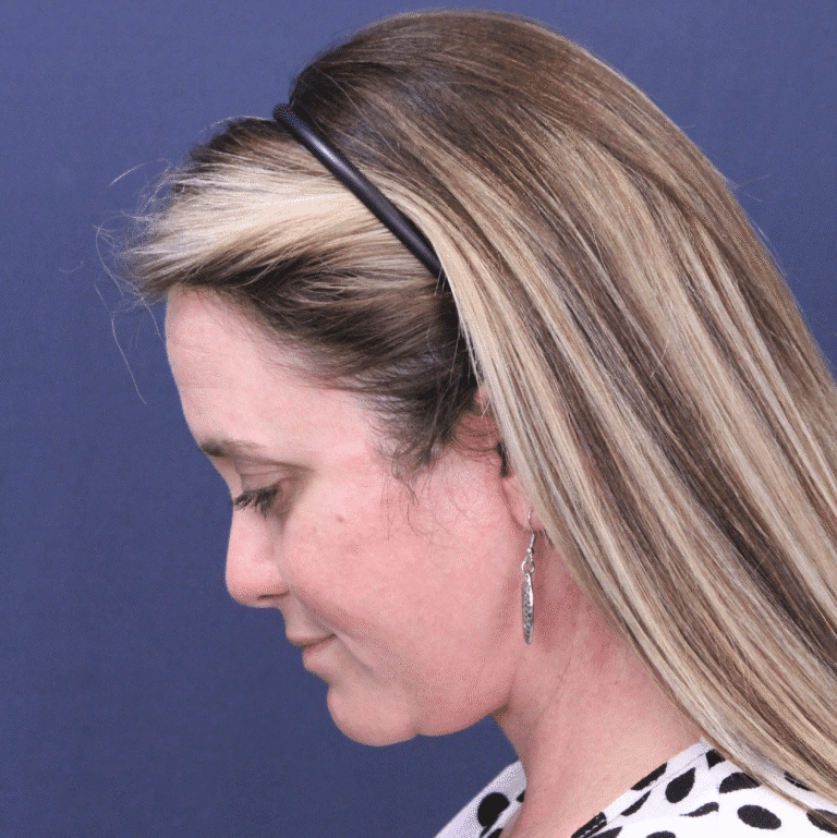 After Image: Facelift and Extended Deep Plane Neck Lift - left-side