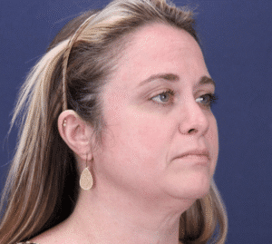 Before Image: Facelift and Extended Deep Plane Neck Lift