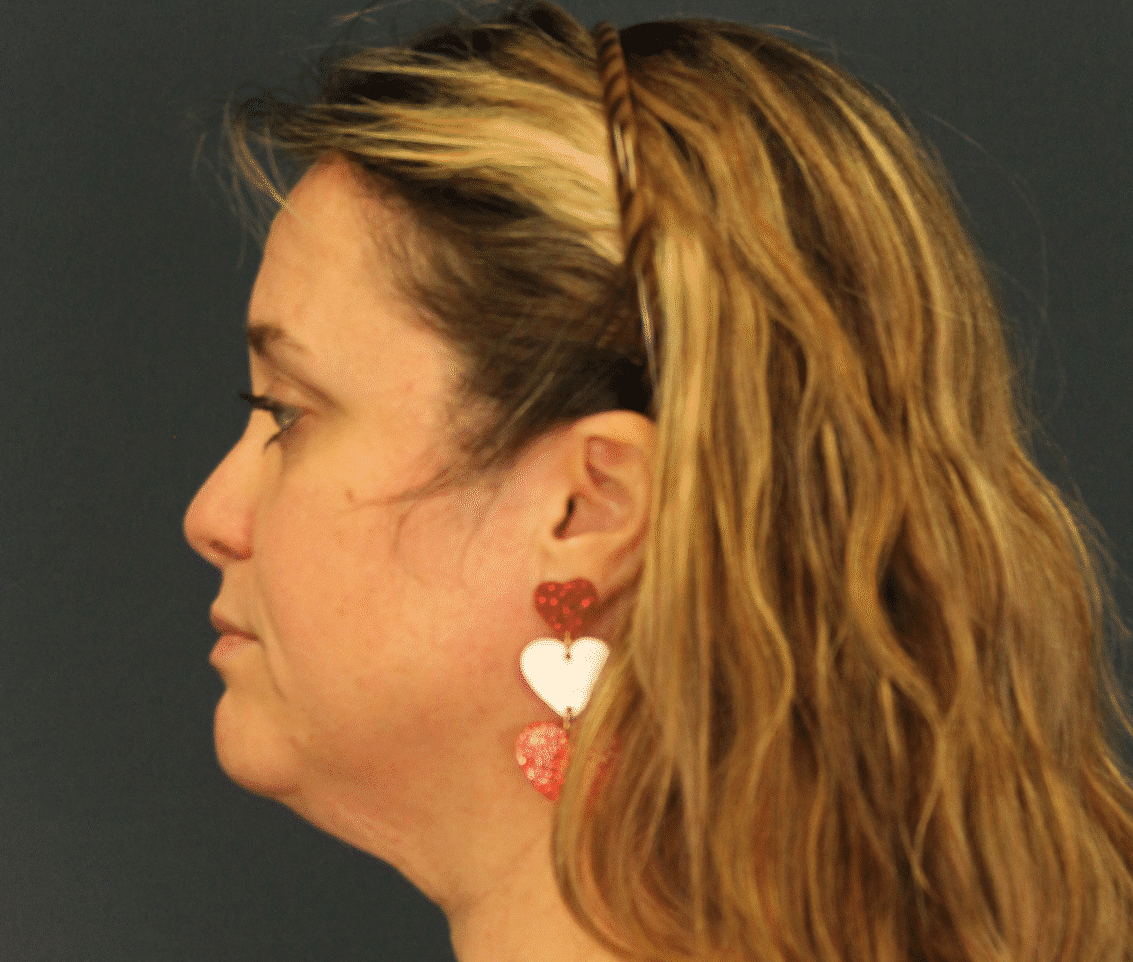 Before Image: Facelift and Extended Deep Plane Neck Lift - left-side