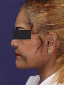 After Image: Deep Plane Neck Lift and Mini Facelift