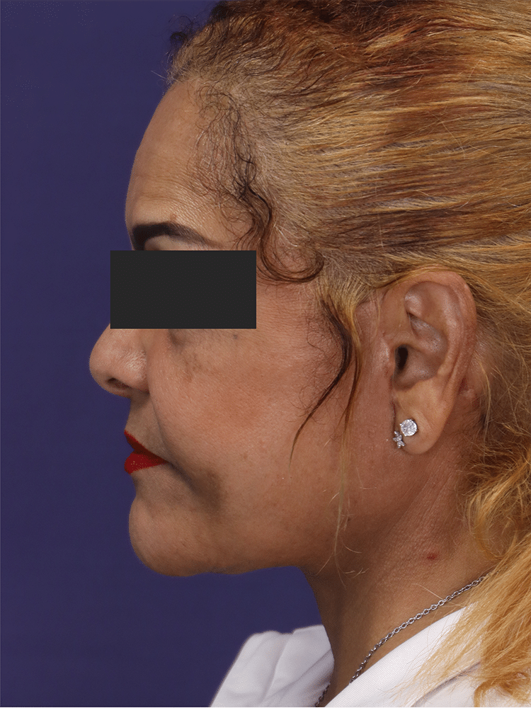 After Image: Deep Plane Neck Lift and Mini Facelift - left-side