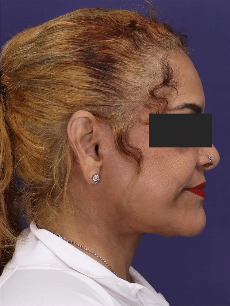 After Image: Deep Plane Neck Lift and Mini Facelift - right-side