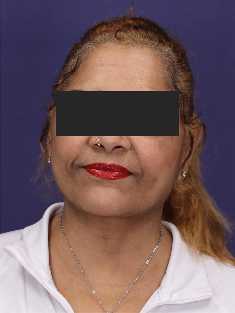 After Image: Deep Plane Neck Lift and Mini Facelift - front