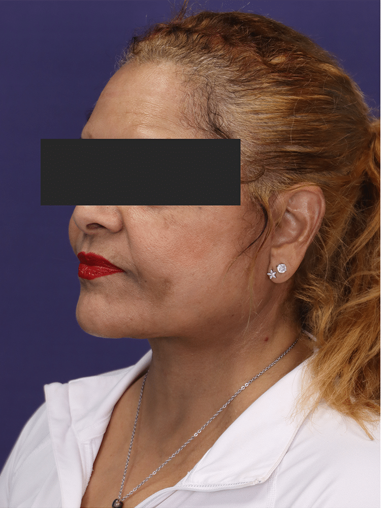 After Image: Deep Plane Neck Lift and Mini Facelift - left-front-oblique