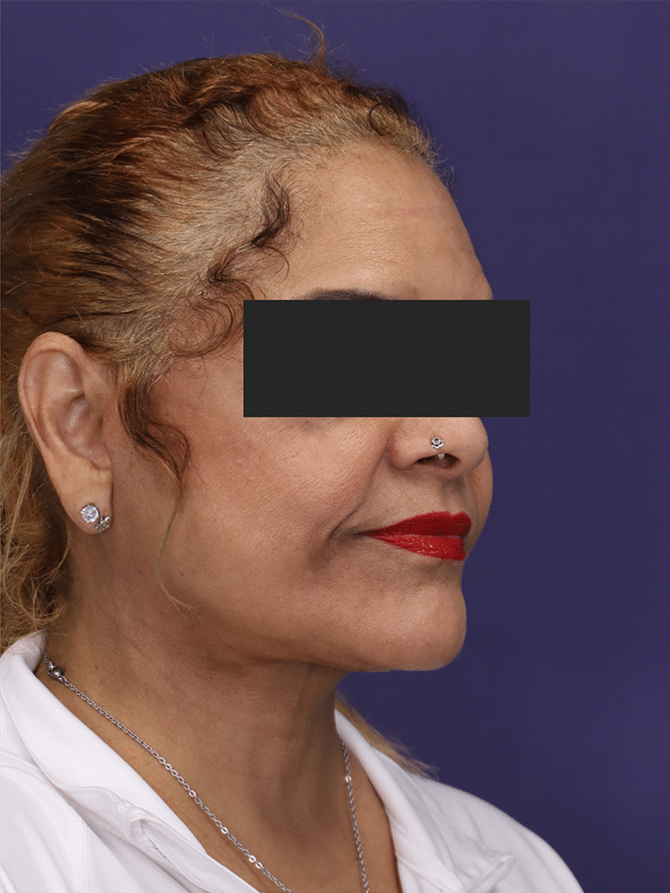 After Image: Deep Plane Neck Lift and Mini Facelift - right-front-oblique