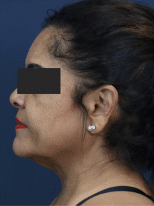 Before Image: Deep Plane Neck Lift and Mini Facelift