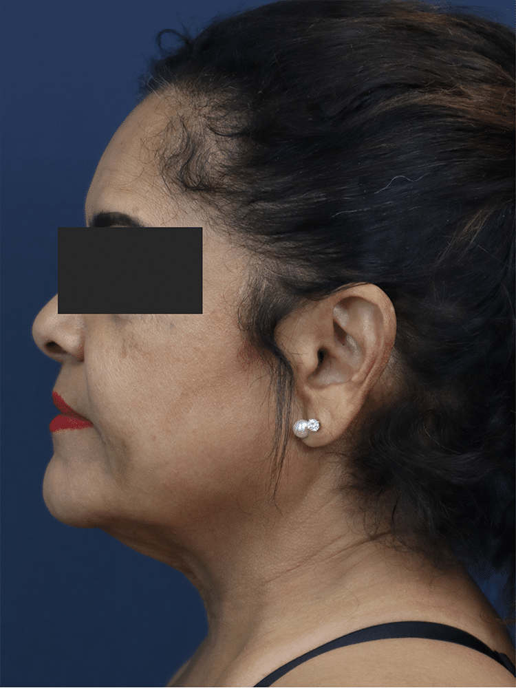 Before Image: Deep Plane Neck Lift and Mini Facelift - left-side