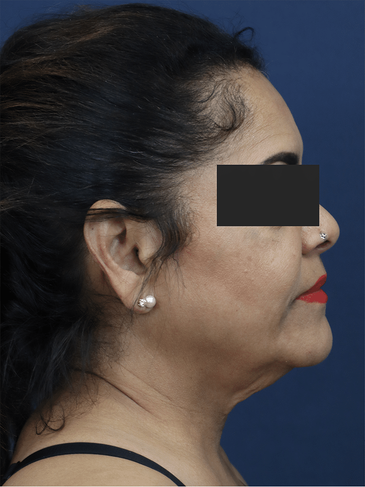 Before Image: Deep Plane Neck Lift and Mini Facelift - right-side
