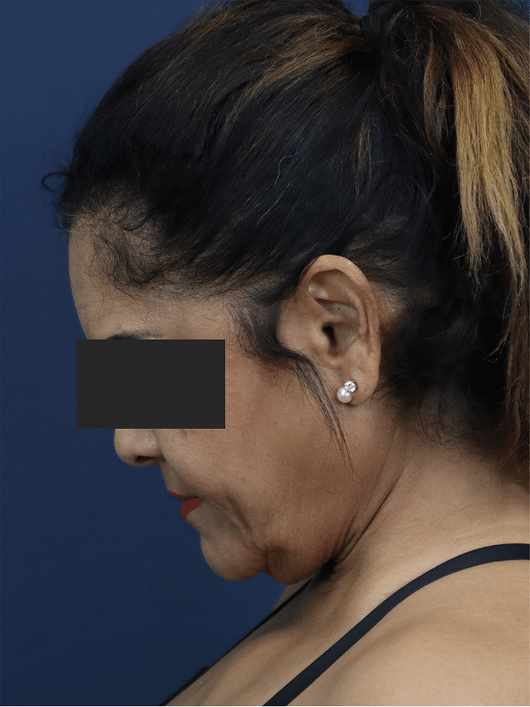 Before Image: Deep Plane Neck Lift and Mini Facelift - left-side