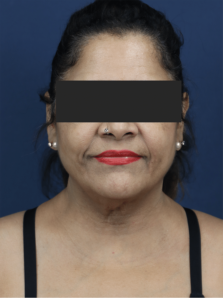 Before Image: Deep Plane Neck Lift and Mini Facelift - front