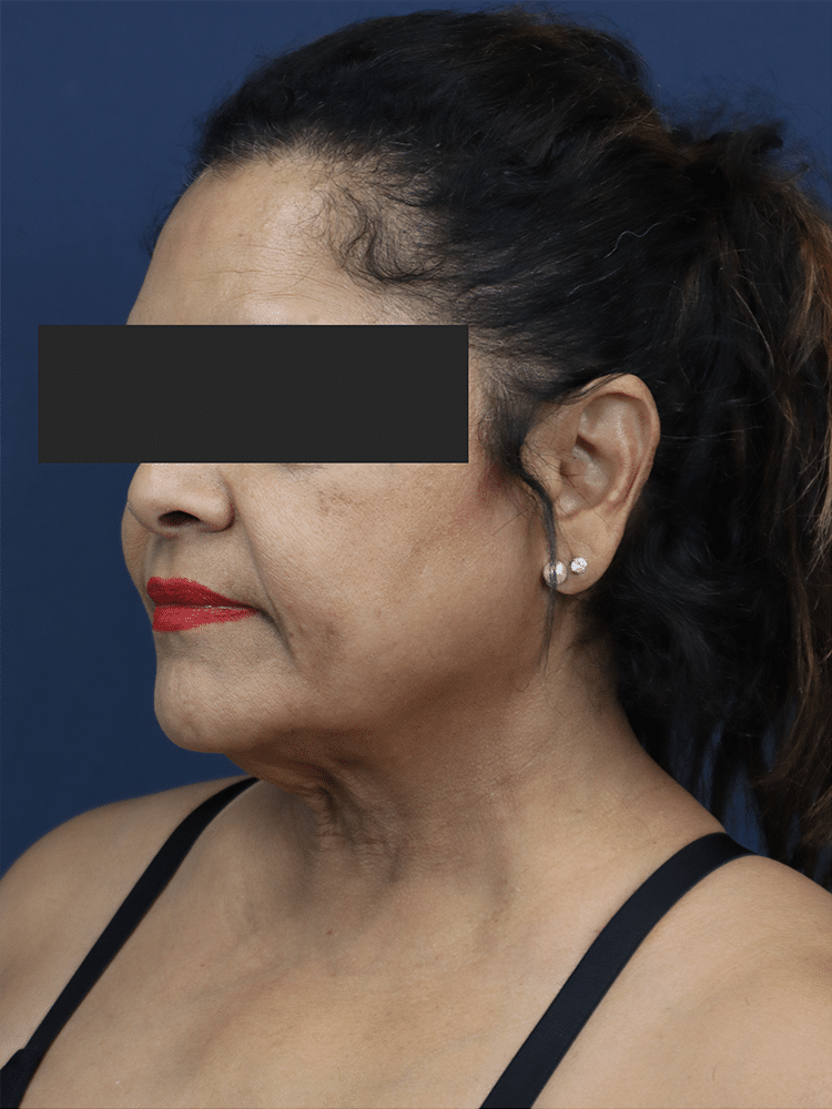 Before Image: Deep Plane Neck Lift and Mini Facelift - left-front-oblique