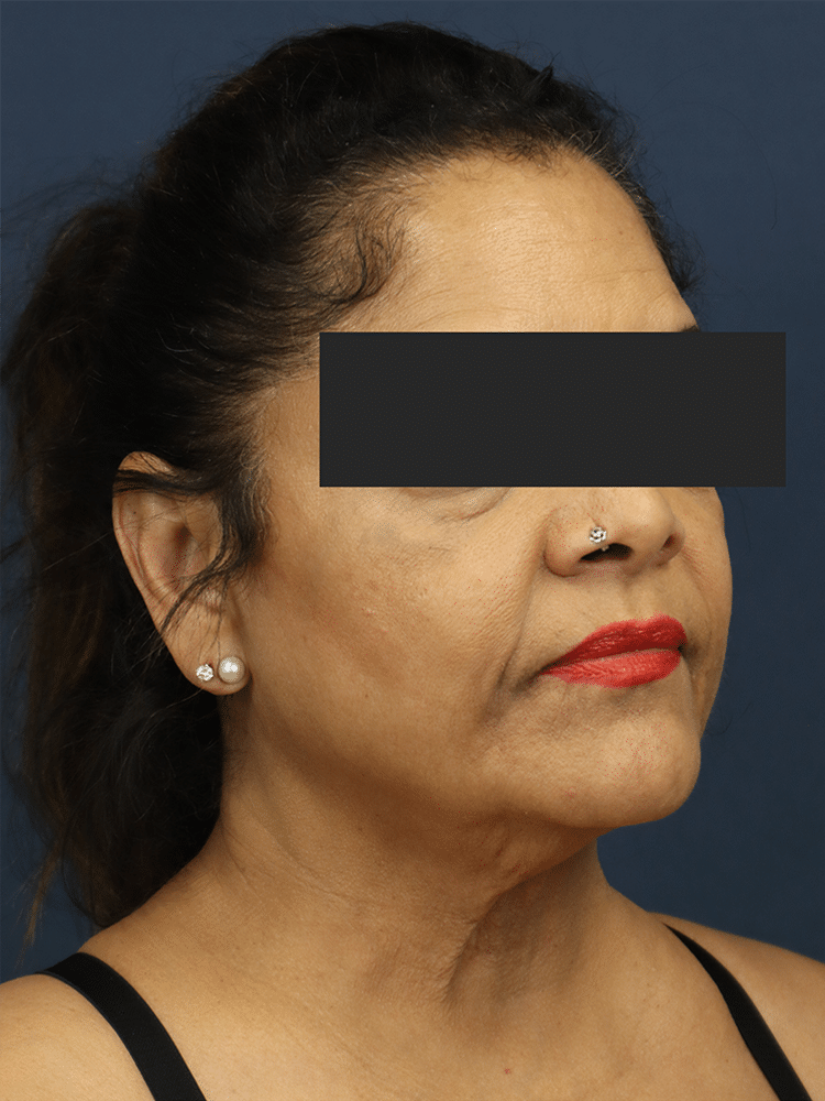 Before Image: Deep Plane Neck Lift and Mini Facelift - right-front-oblique