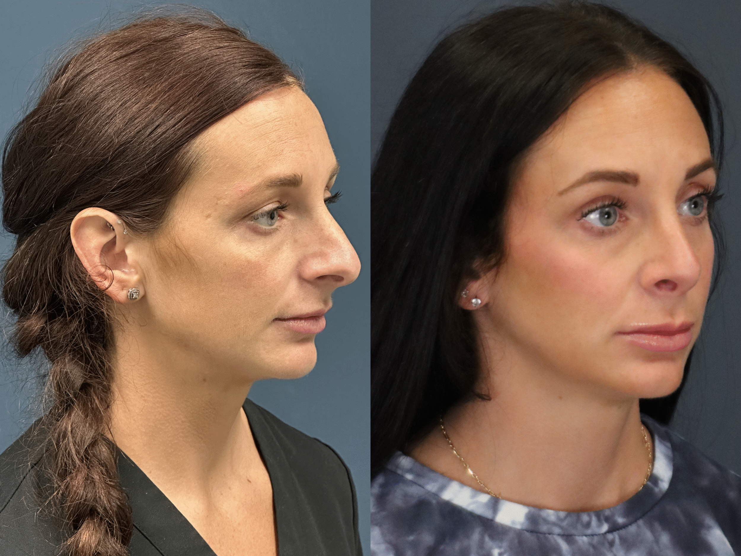 Before Image: Rhinoplasty - front