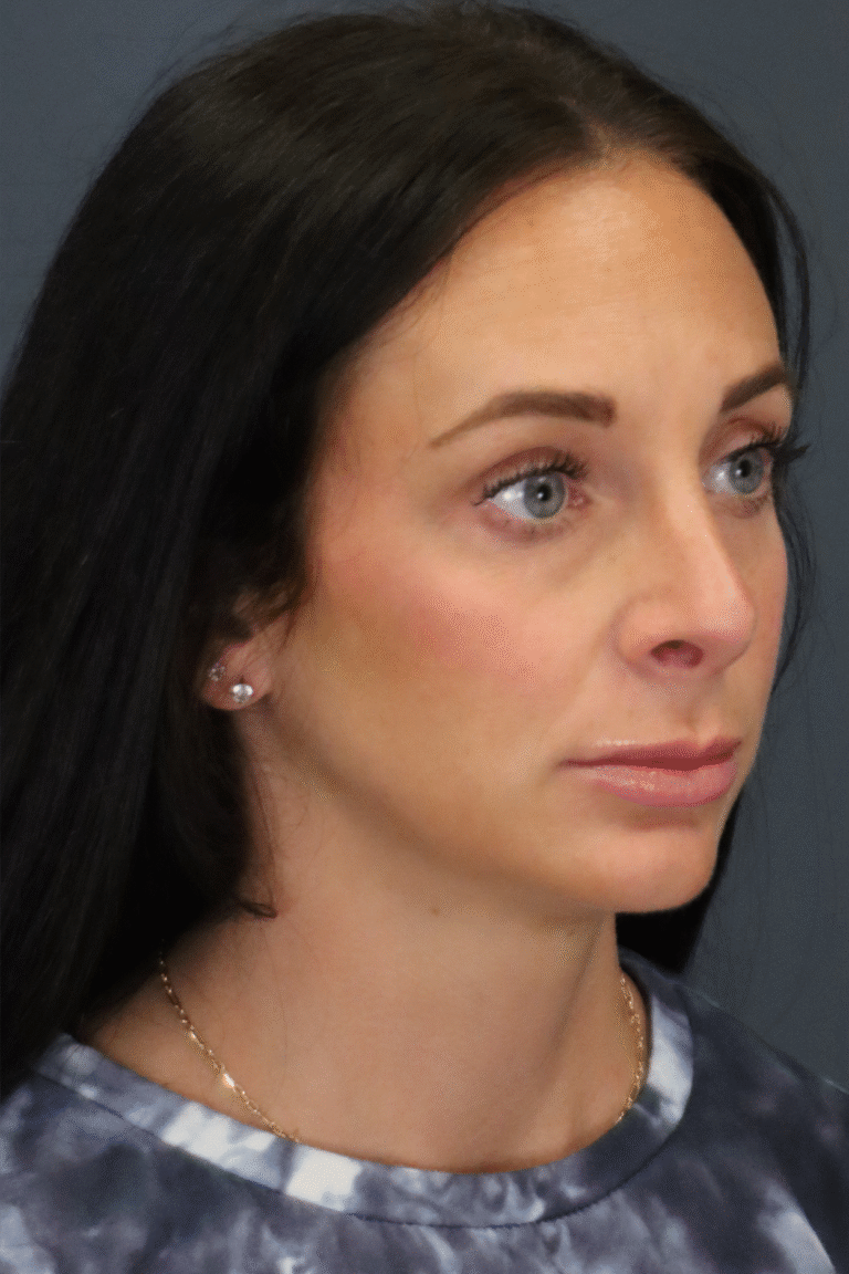 After Image: Rhinoplasty - front