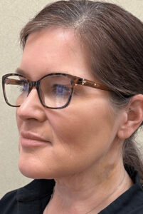 After Image: MyEllevate Minimally Invasive Neck Lift