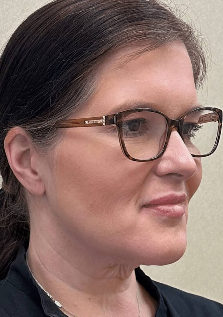 After Image: MyEllevate Minimally Invasive Neck Lift - right-front-oblique