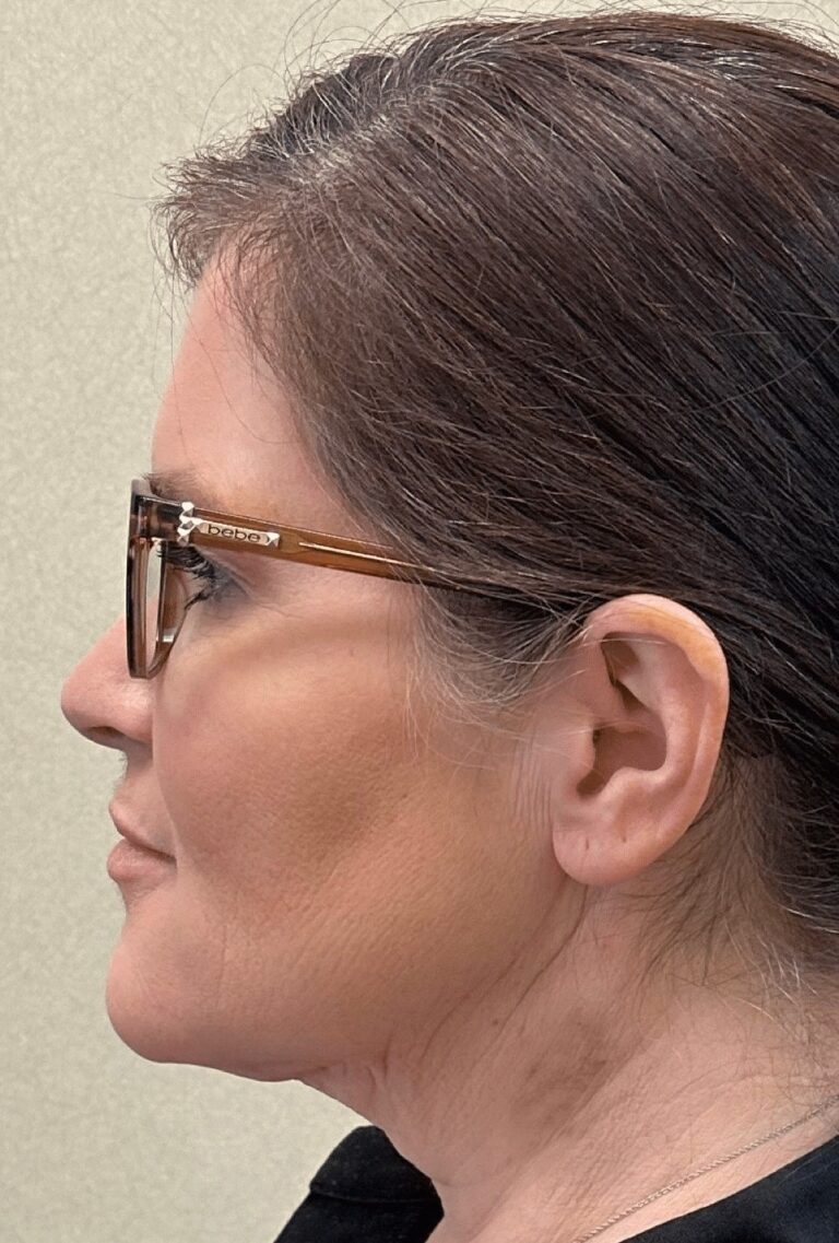 After Image: MyEllevate Minimally Invasive Neck Lift - left-side