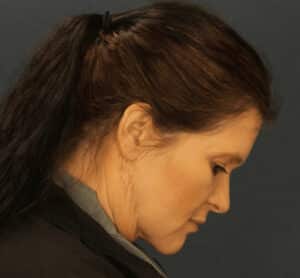 After Image: Minimally Invasive Neck Lift