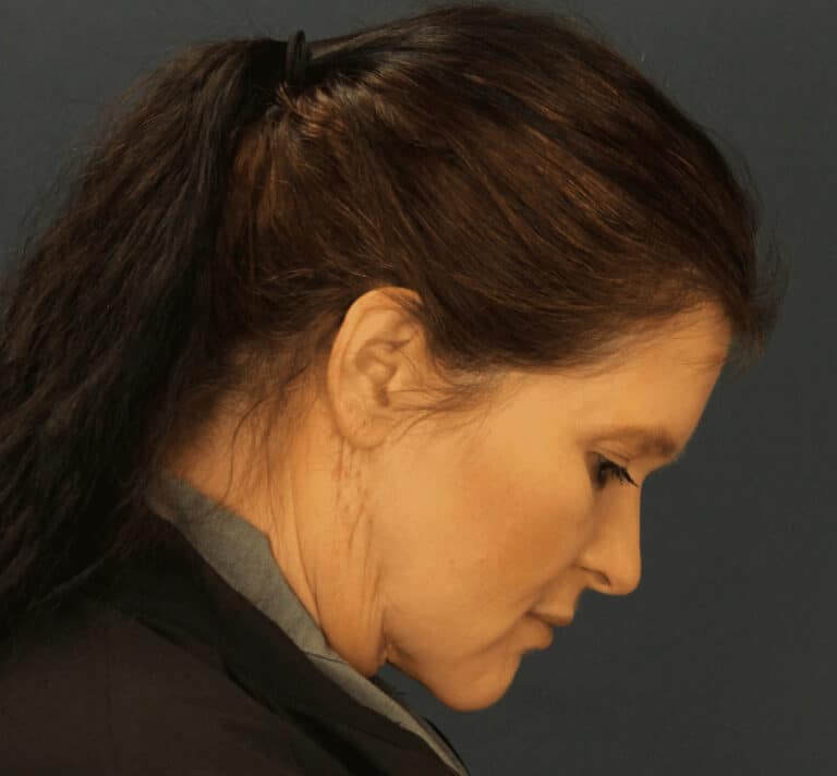After Image: MyEllevate Minimally Invasive Neck Lift - right-side