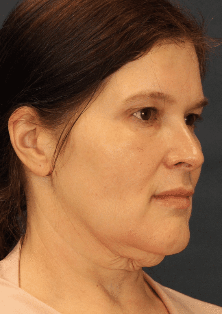 Before Image: MyEllevate Minimally Invasive Neck Lift - right-front-oblique
