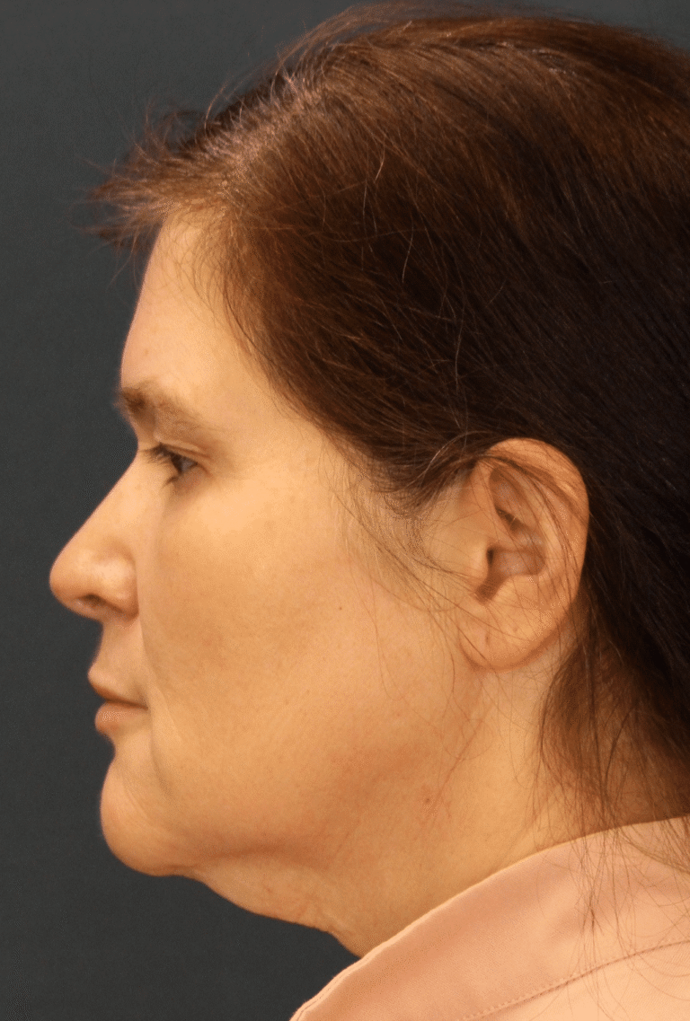 Before Image: MyEllevate Minimally Invasive Neck Lift - left-side
