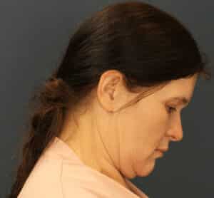 Before Image: Minimally Invasive Neck Lift
