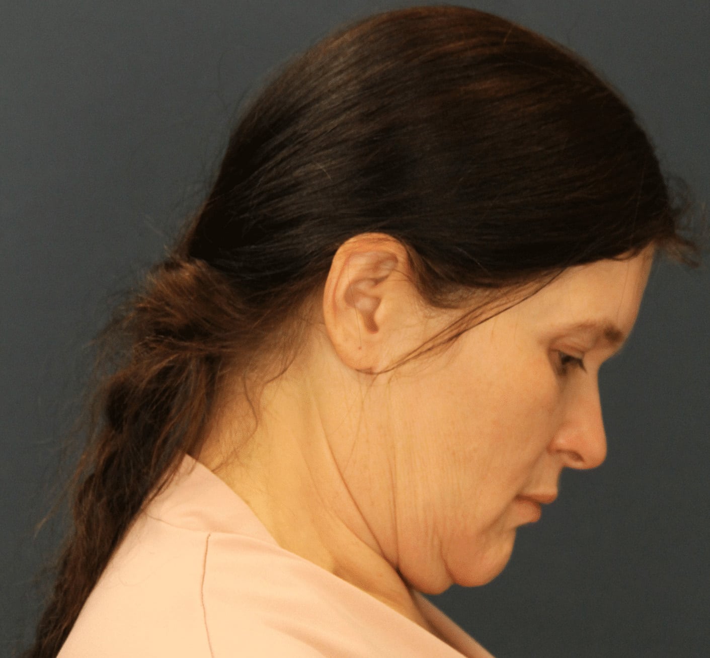 Before Image: Minimally Invasive Neck Lift - right-side