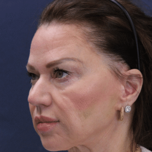 Before Image: Upper and Lower Eyelid Lift, Lower Eyelid Profractional Laser