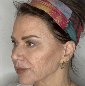 After Image: Upper and Lower Eyelid Lift, Lower Eyelid Profractional Laser