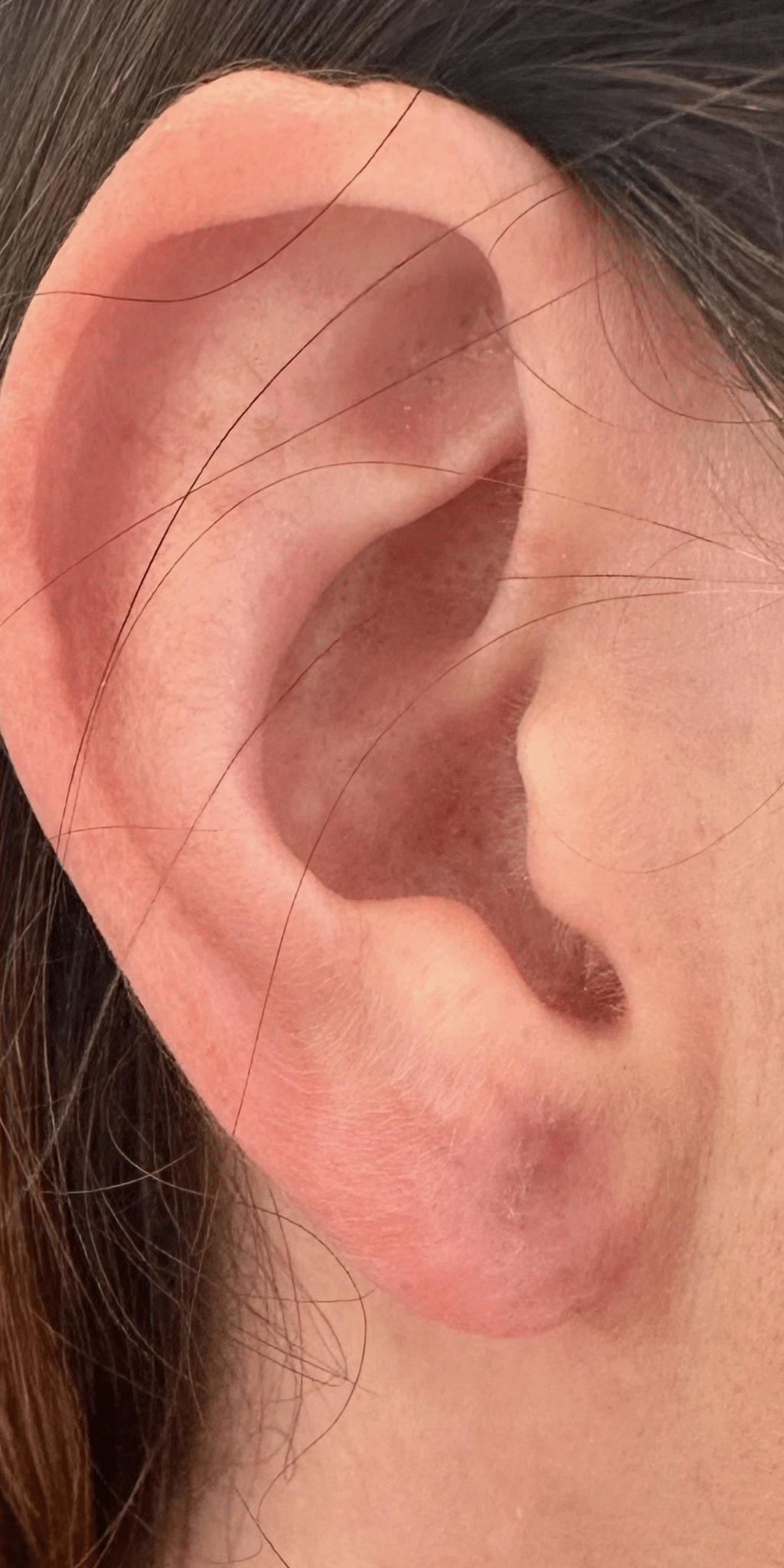 After Image: Earlobe Repair - right-side