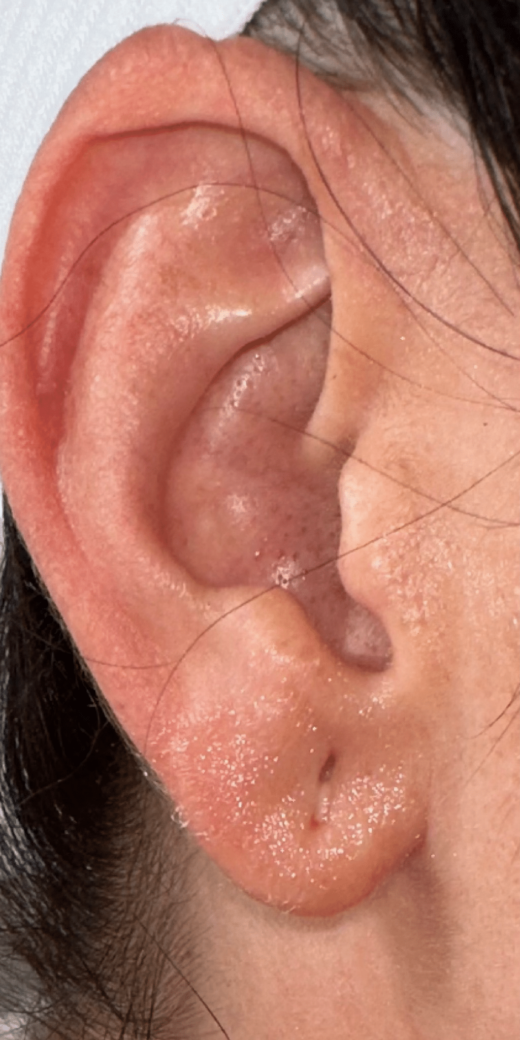 Before Image: Earlobe Repair - right-side