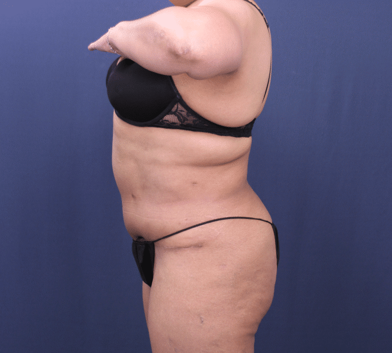After Image: Bella Body Lift - left-side