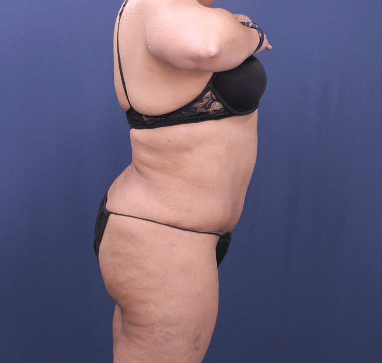 After Image: Bella Body Lift - right-side