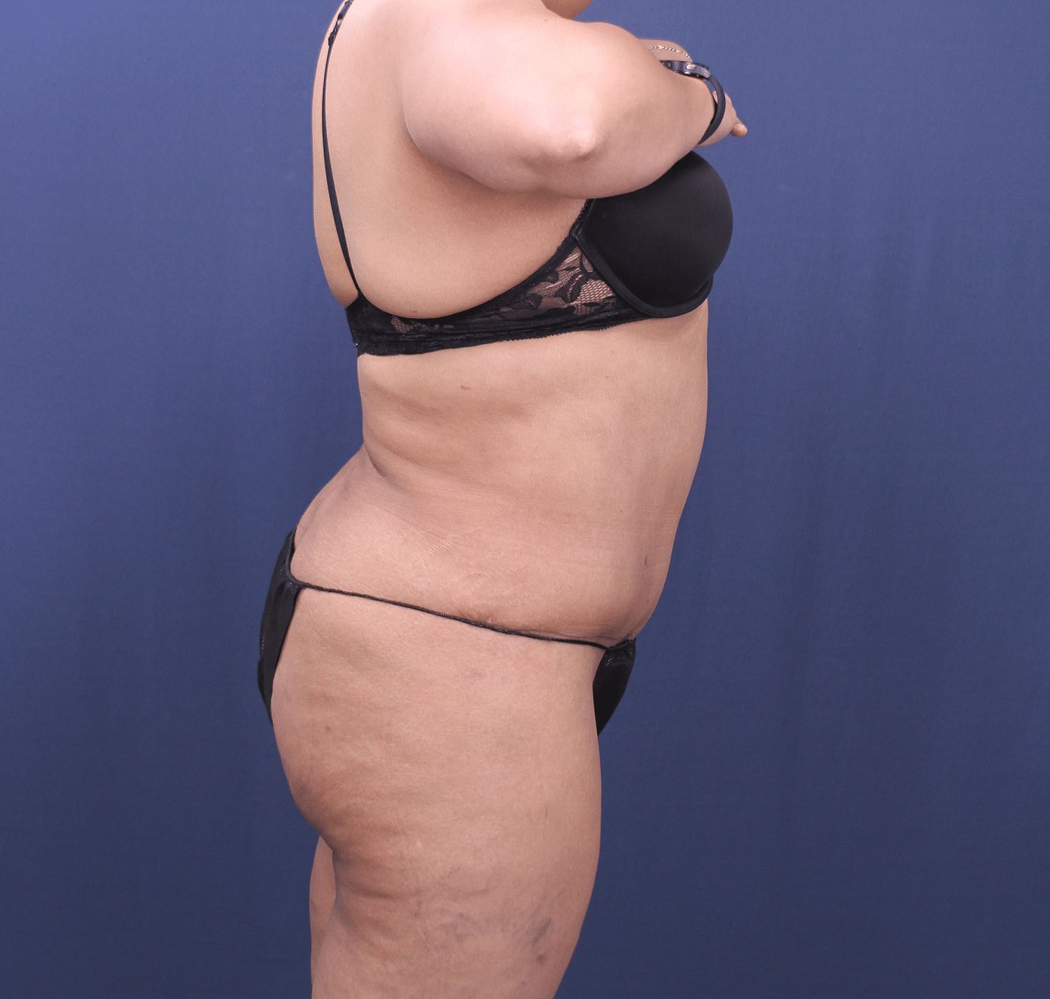 After Image: Bella Body Lift - right-side