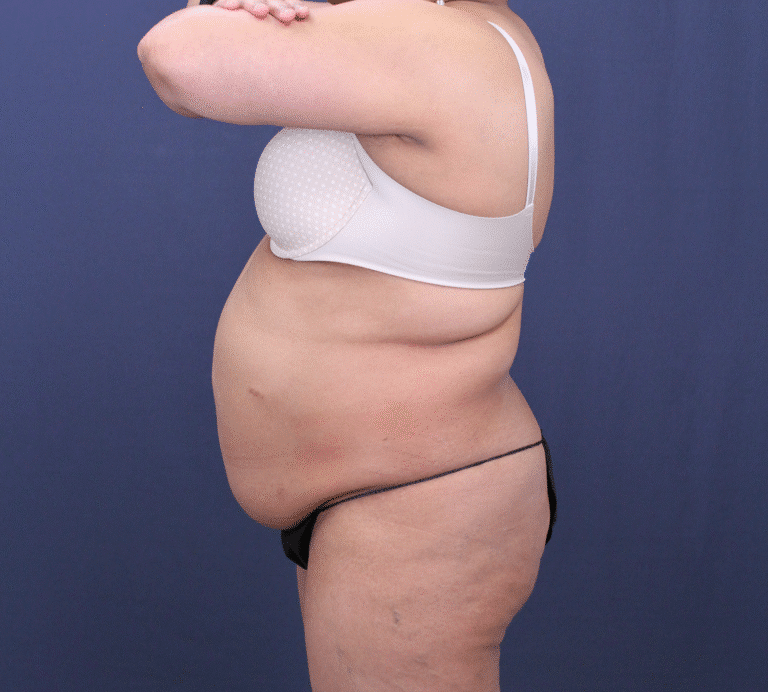 Before Image: Bella Body Lift - left-side