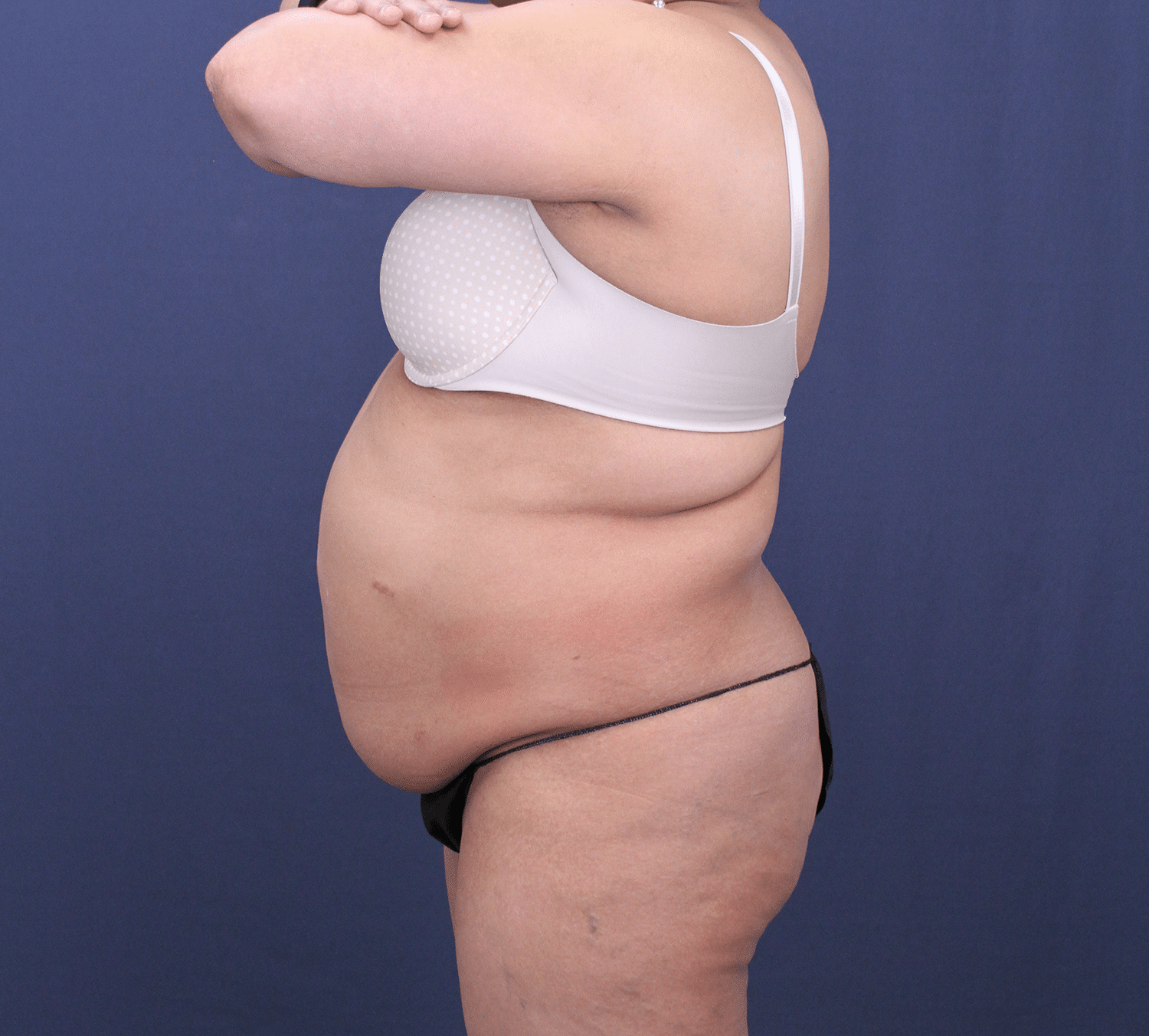 Before Image: Bella Body Lift - left-side