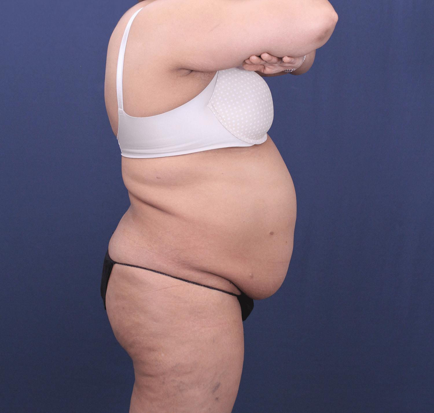 Before Image: Bella Body Lift - right-side