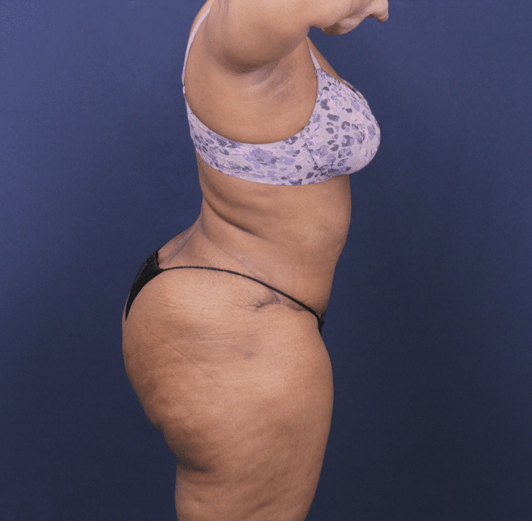 After Image: Bella Body Lift - right-side