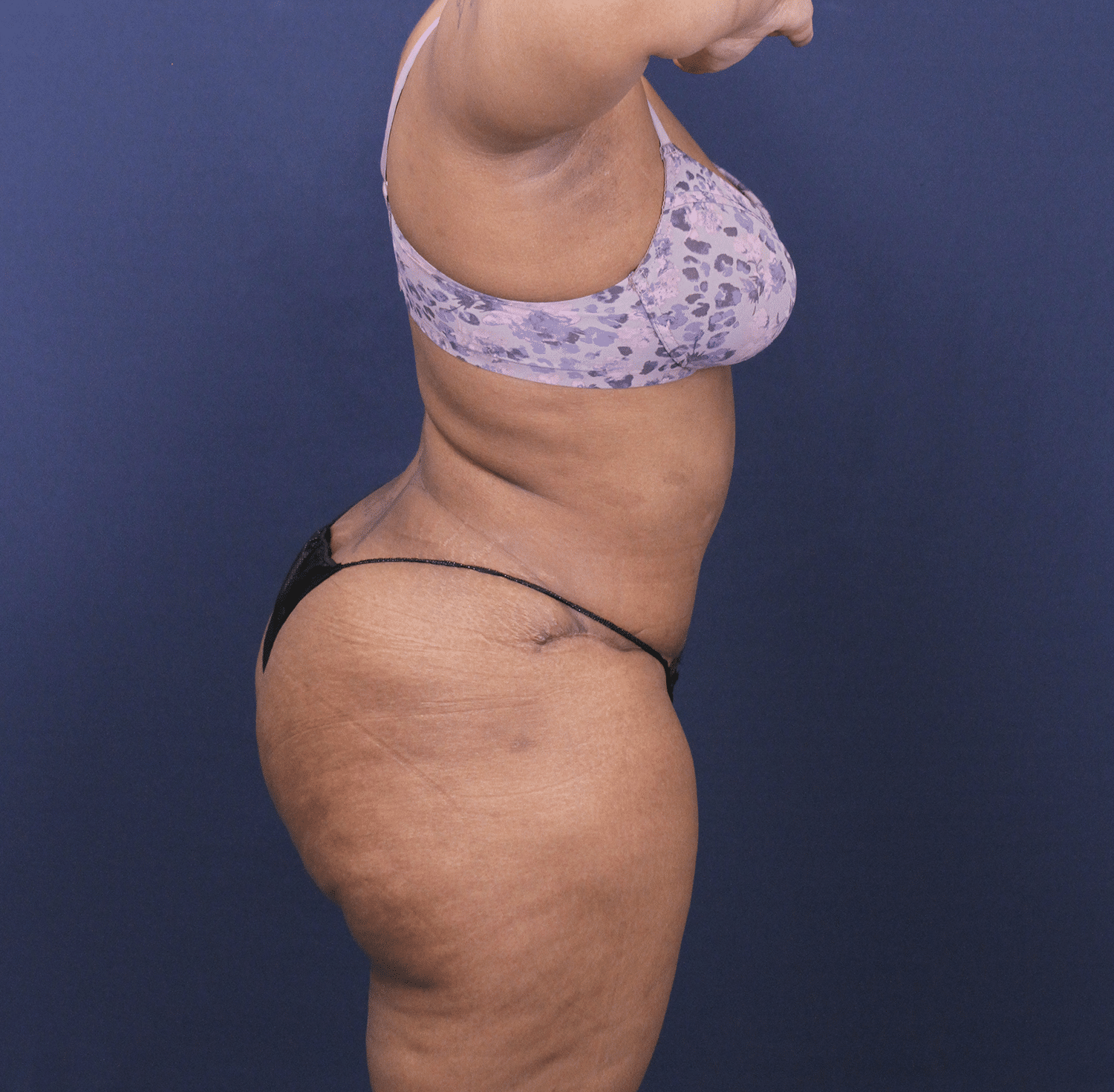 After Image: Bella Body Lift - right-side