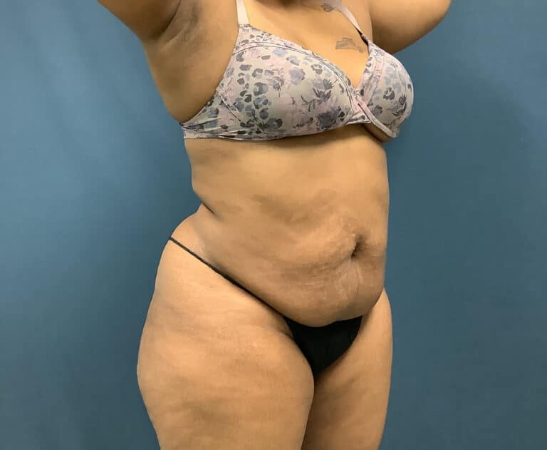 Before Image: Bella Body Lift - right-front-oblique