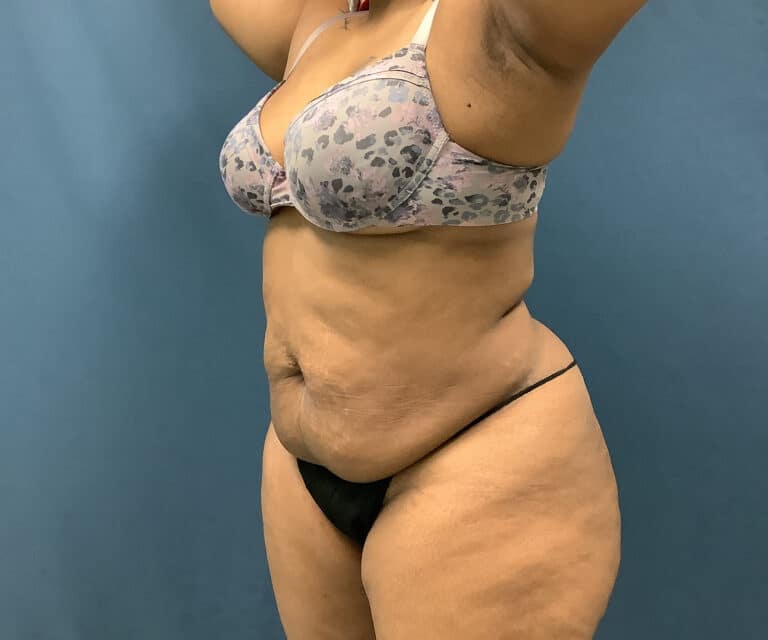 Before Image: Bella Body Lift - left-front-oblique