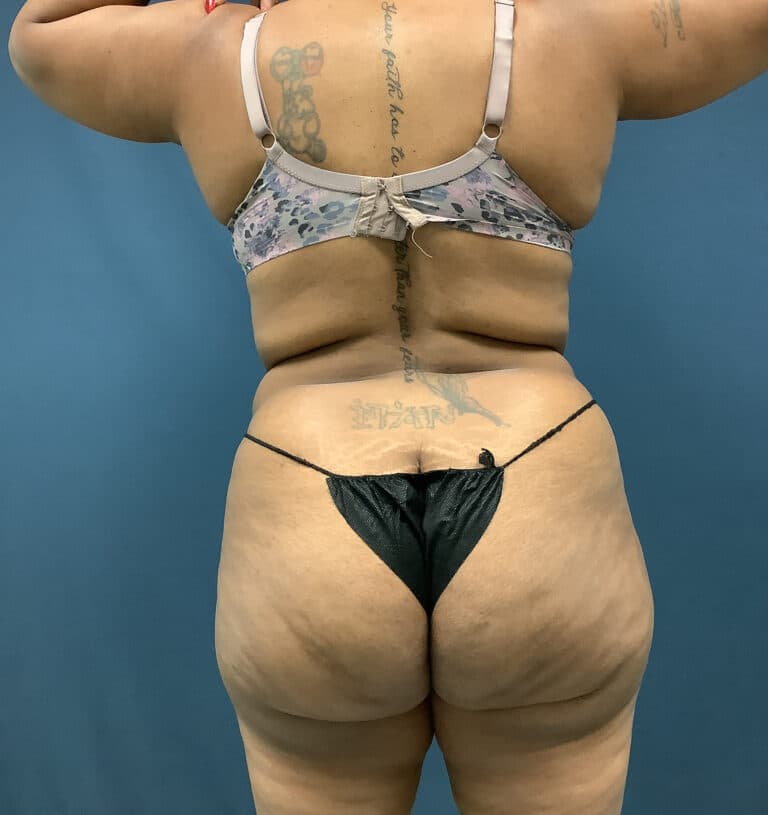 Before Image: Bella Body Lift - back